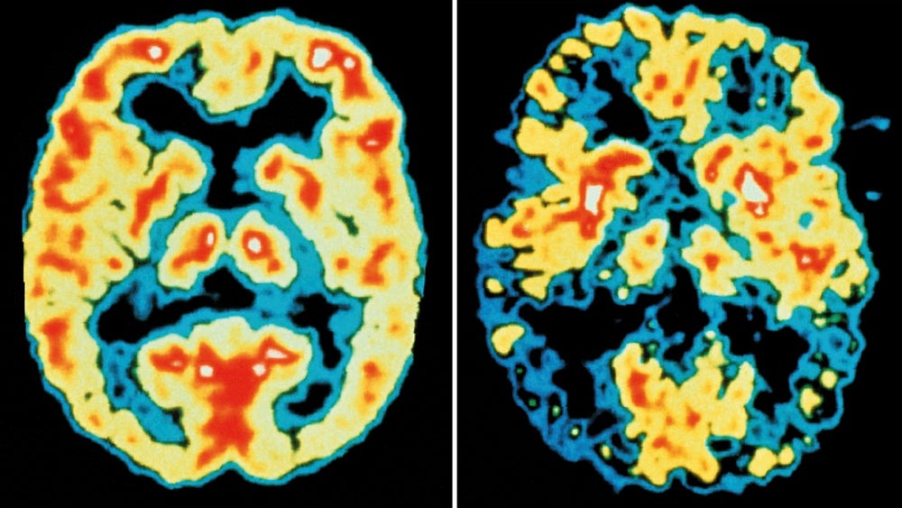 Ny forskning: Medicin bromsar alzheimer