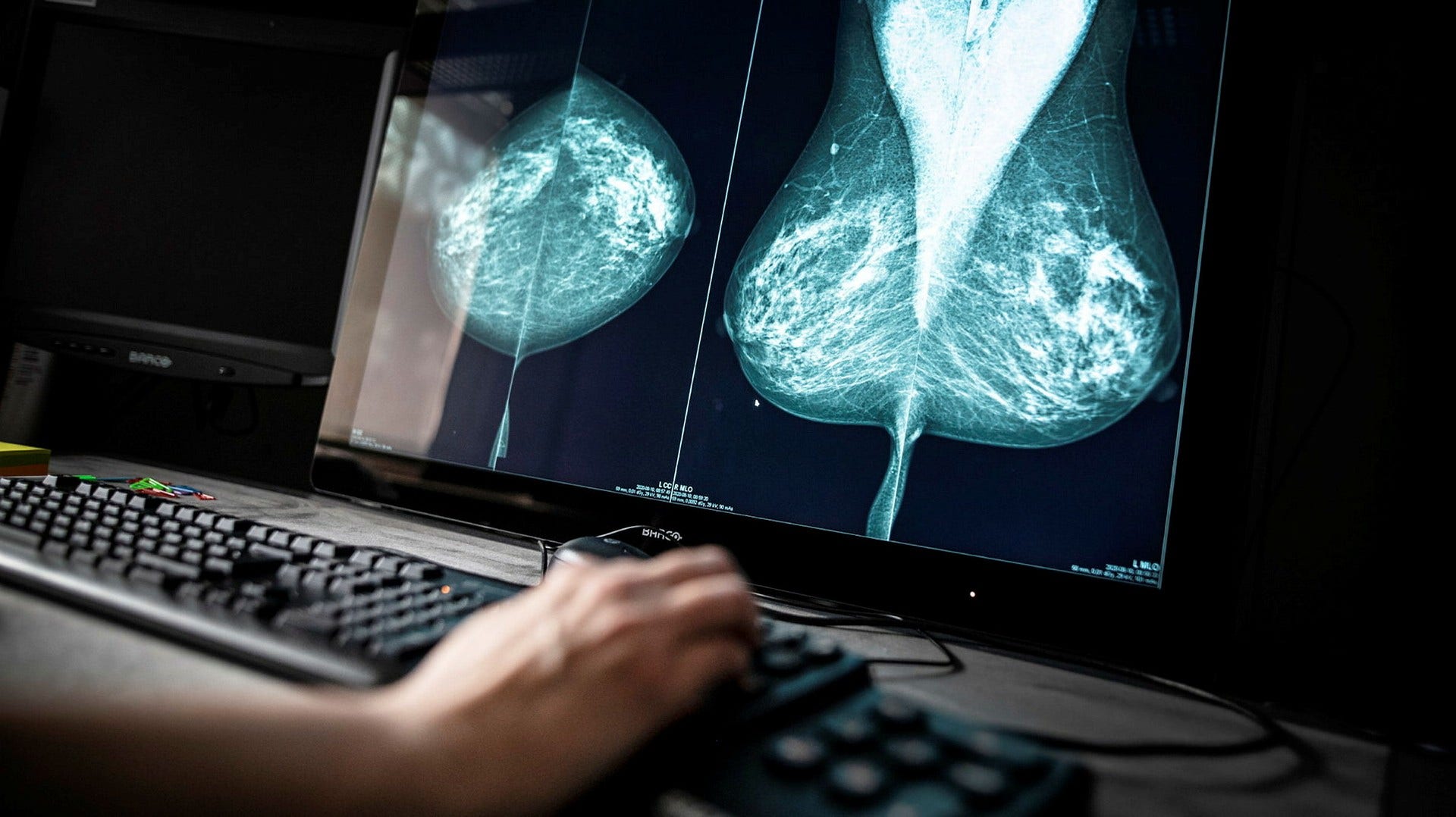 Nationella screeningprogram kan vara effektiva, visar Sveriges arbete med mammografi. Men vad gäller andra cancerformer har vi som land inget att skryta med, skriver artikelförfattarna.