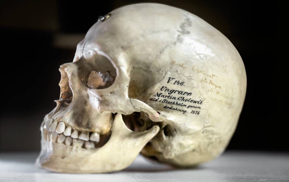 Ungraren Cholewit begravdes sannolikt aldrig. Han hamnade omedelbart under anatomernas verktyg.