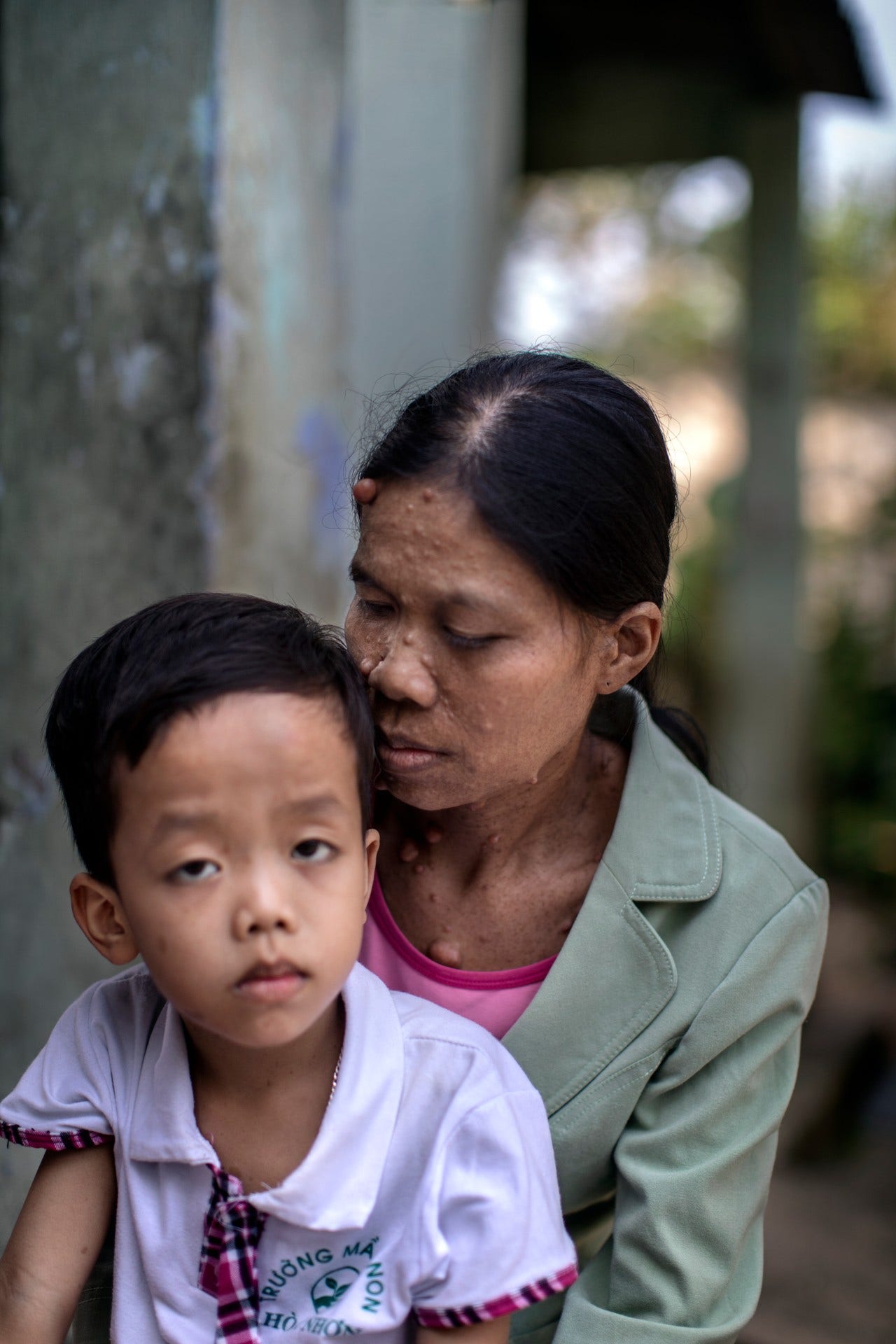 Nguyen Thi Ha, 37 år, har konstanta smärtor, är nästan blind på ena ögat och ansiktet täcks av bölder. Hennes son Truong Quoc Thieu, 6 år, reagerar inte på tilltal och anses tillhöra tredje generationen Agent Orange-offer, genom att hans morfar exponerades för växtgiftet.