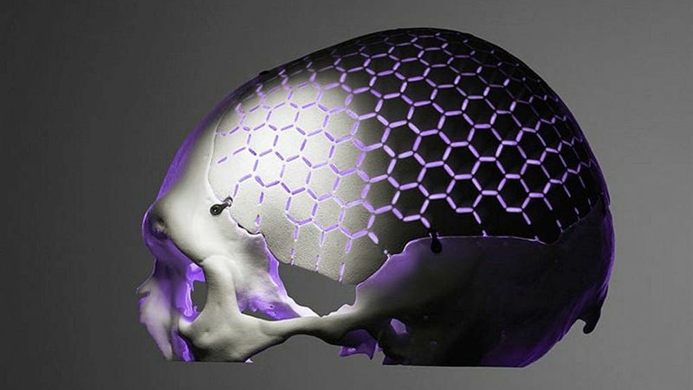 SEB Venture Capital säljer allt i medicinteknikbolag – till 11,9 procents rabatt